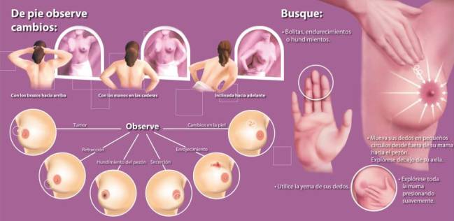 Cáncer de mama