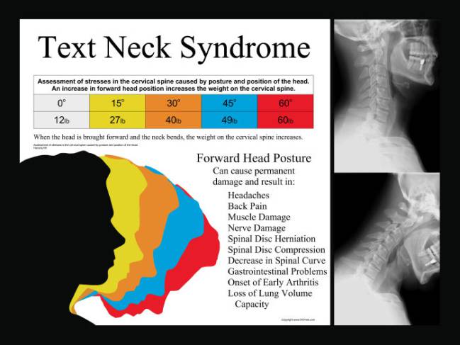 Síndrome de Text Neck, que puede provocar molestias en el cuello