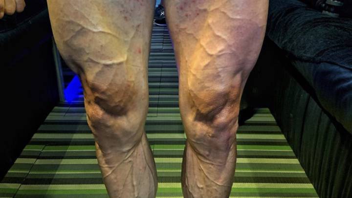 Imagen de las piernas de José Joaquín Rojas tras la disputa de las 12 primeras etapas del Giro de Italia.