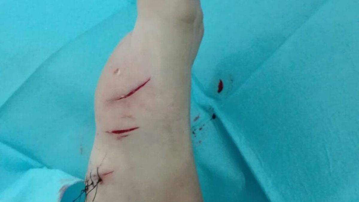 Ataque tiburón a niño en Gran Canaria heridas