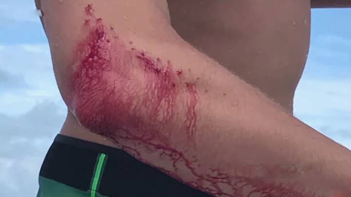 El mordisco de un tiburón al surfista Frank O'Rourke, cuyo codo sangraba intensamente.