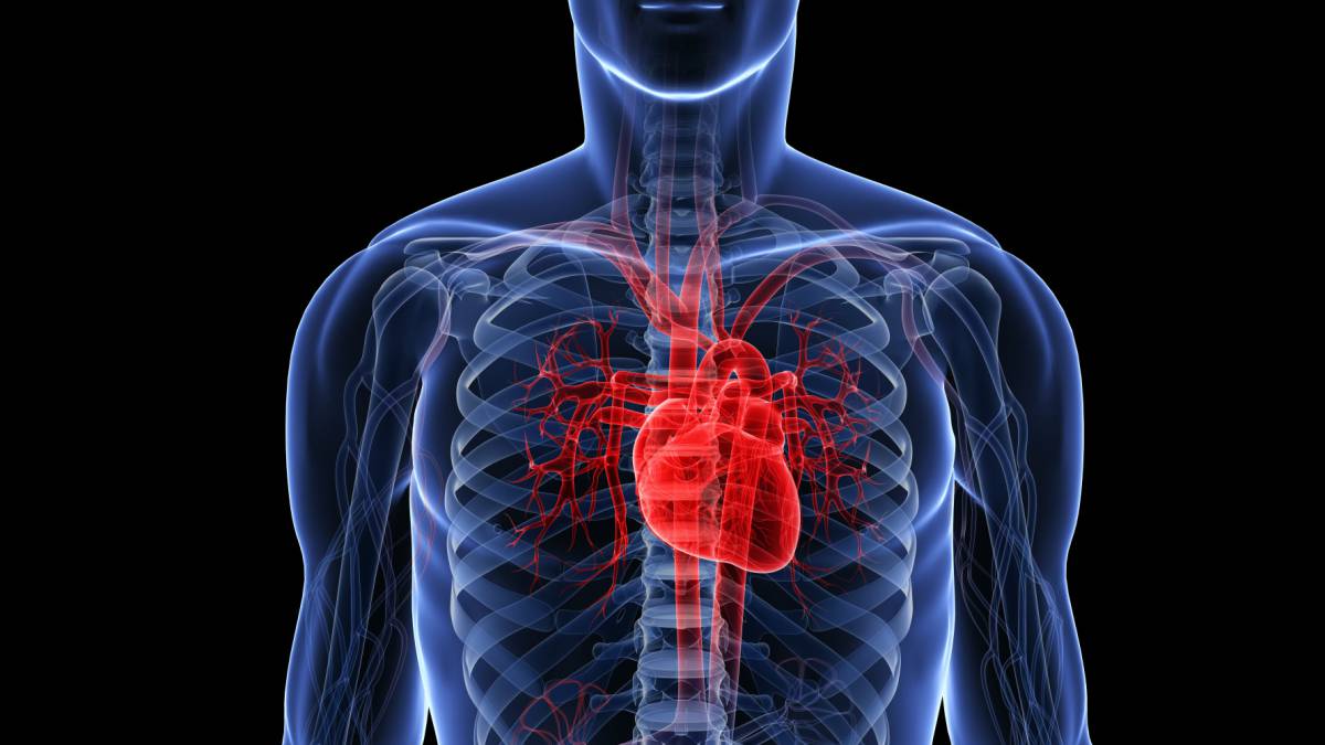 infarto