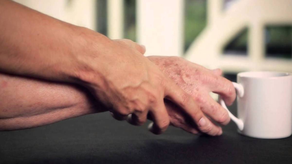 parkinson