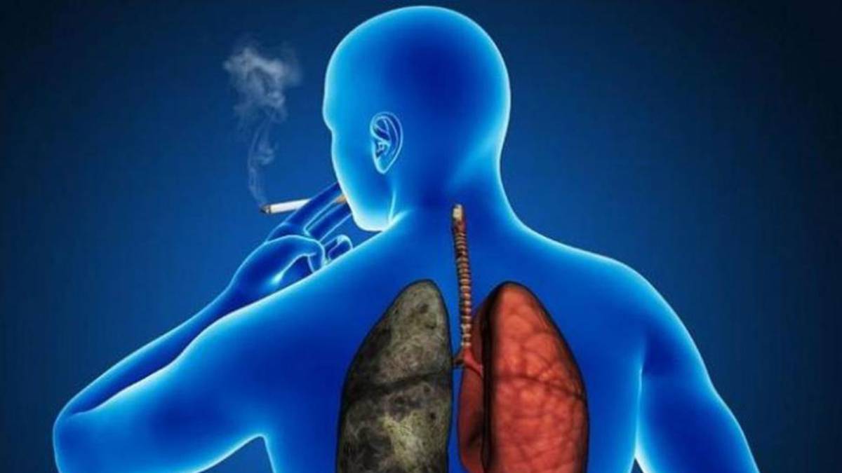 cáncer pulmón