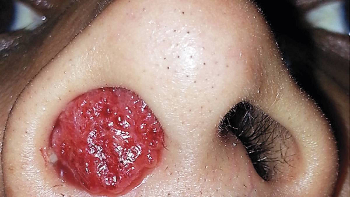 Rinosporidiosis, emfermedades, salud, enfermedad rara, infección