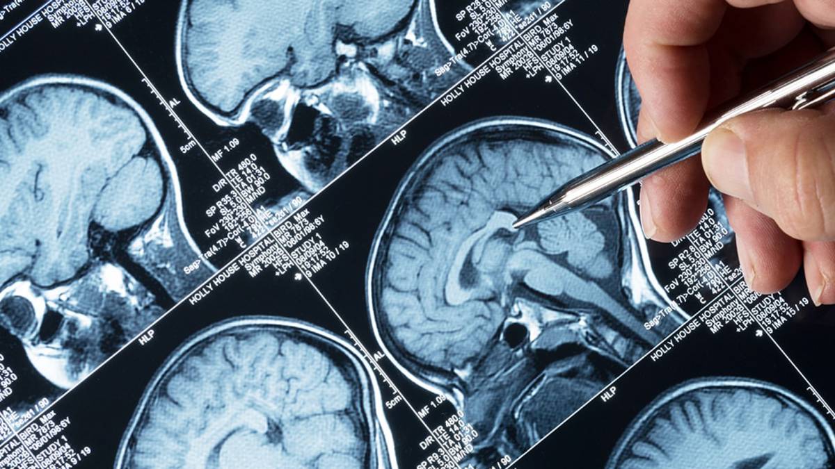 epilepsia