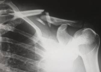 Un estudio revela que la osteoporosis no es solo cosa de mujeres