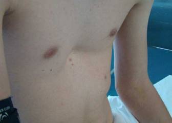 Deformidad de la cavidad torácica: pectus excavatum y pectus carinatum