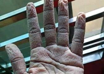 Así queda la mano de un médico después de llevar guantes durante sus 10 horas de trabajo