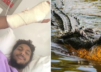 Un joven cuenta cómo se salvó del ataque de un cocodrilo: 
