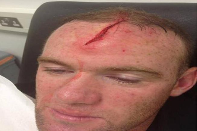 Wayne Rooney está de baja por un corte profundo en la cabeza