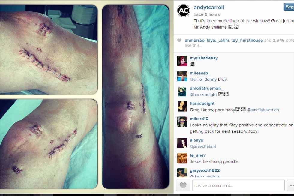 Andy Carroll muestra el aspecto de su rodilla tras la operación