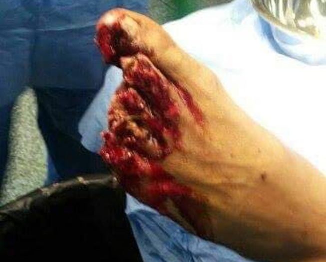 ametuer dedos de los pies ametuer dedos de los pies