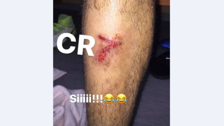 Fabinho se toma con humor la herida en forma de 7 en una pierna, producida en el Mónaco 3-1 Touluse de la Ligue 1, y se acuerda en redes sociales de su excompañero Cristiano Ronaldo.