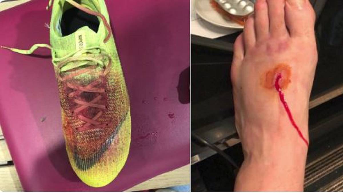 Así quedó el empeine de Lucas Pérez tras un pisotón.