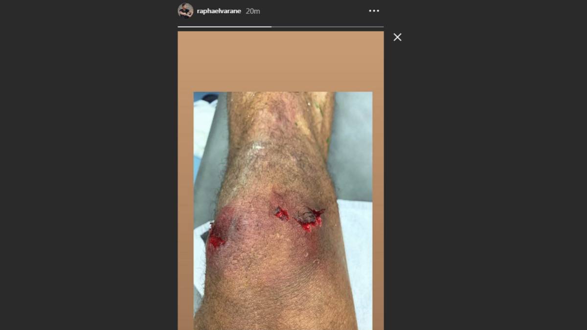 Real Madrid's Varane shows off injury picked up for own goal