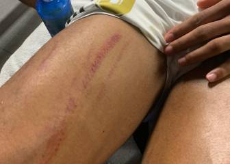 Varane left with stud-marked leg as Real bemoan penalty calls