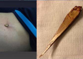 Escalofriante: Bebe se clava una astilla de 10 cm en el primer amistoso del Movistar