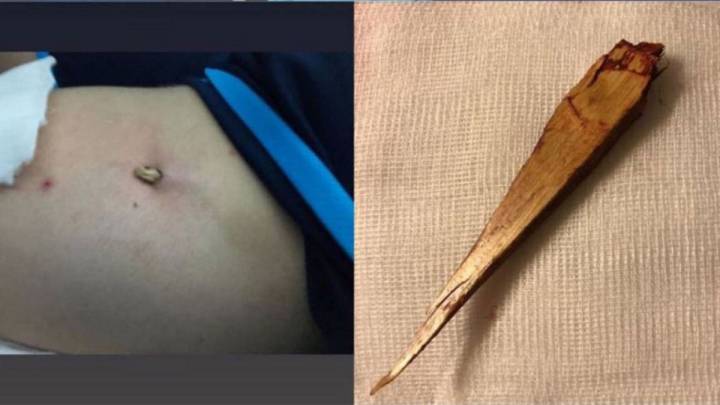 Escalofriante: Bebe se clava una astilla de 10 cm en el primer amistoso del Movistar