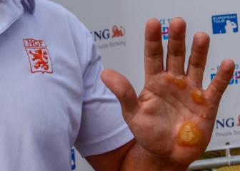 Un golfista muestra sus manos tras golpear 1.000 bolas al día