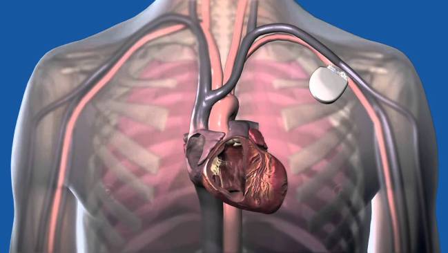Cómo funciona un desfibrilador implantado