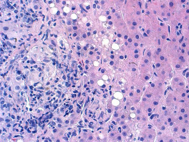 hepatitis
