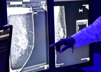 Campañas de salud gratuitas en Azcapotzalco: diabetes, hipertensión, mastografías y VIH