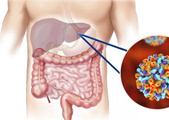 Día Mundial contra la Hepatitis: diferencias entre la A, B y C