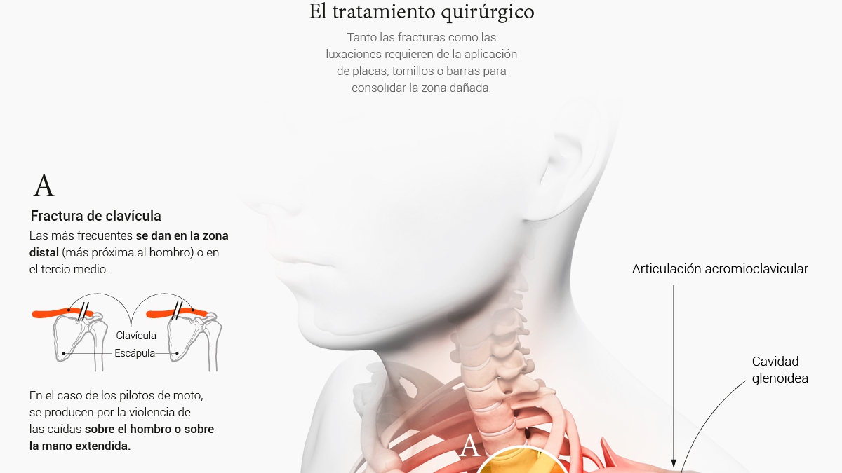 Lesiones más habituales y análisis del mono con airbag