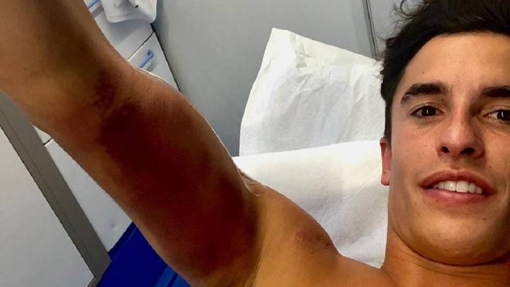 Así buscó Márquez lo imposible: hizo 17 flexiones en el hospital