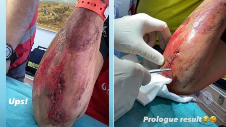 El brazo de Laia Sanz tras su caída en el Rally de Andalucía.