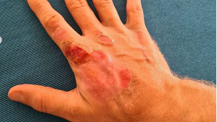 Así está la mano derecha de Grosjean tras el accidente