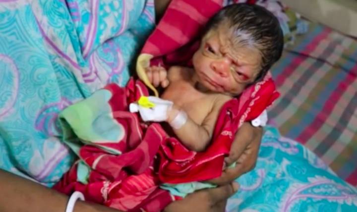 Nace en Bangladesh un “bebé anciano”