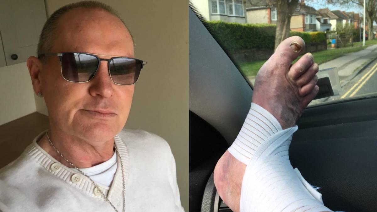Gascoigne muestra su lesión... y sus seguidores se fijan en sus uñas