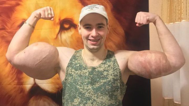 popeye ruso biceps aceite inyectado cirugía estética nueva operacion peligro vida muerte synthon redes sociales