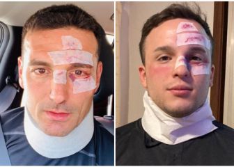 Halloween en Argentina: se disfrazó de Lionel Scaloni ¡después de accidentarse!