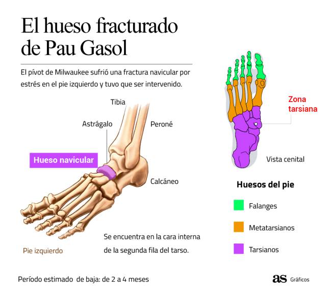 El hueso fracturado de Pau Gasol.