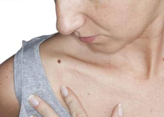 Desarrollan una nueva técnica para la detección del melanoma