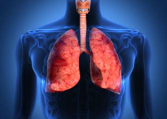 La fibrosis pulmonar idiopática afecta a 7.500 españoles y todavía no tiene cura