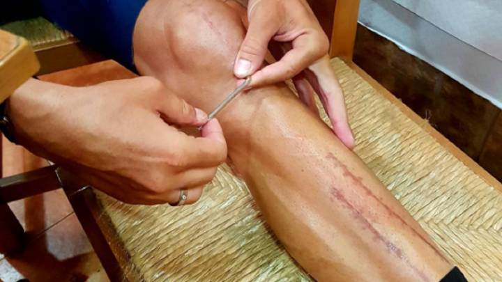 Valverde muestra sus cicatrices y sigue con su recuperación