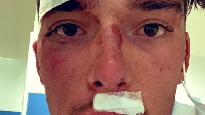 Simon Pellaud muestra sus heridas en la cara tras la dura caída que sufrió en el Giro dell'Emilia tras fallarle los frenos de disco de su bicicleta.