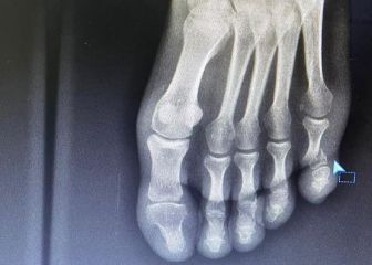 Urán se fractura un dedo del pie al tropezar con su cama