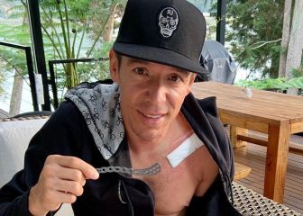 A Rigoberto Urán le retiran una placa de la clavícula