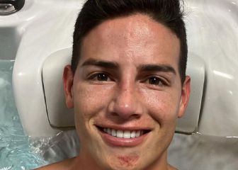 James y las marcas del golpe: nariz, mandíbula y costilla