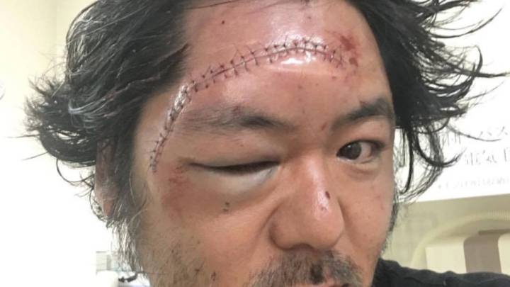 Herida Foil prohibición anglet