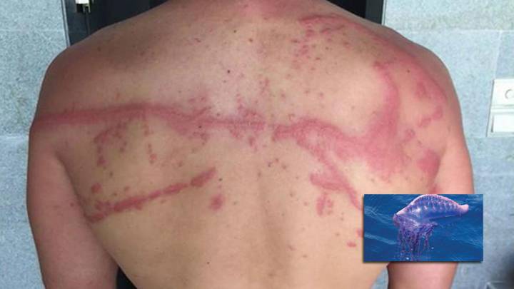 espalda reportero jano mecha picadura carabela portuguesa programa ana rosa telecinco