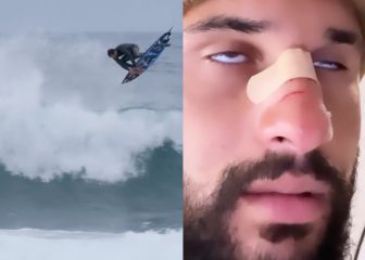 El campeón olímpico se rompe la nariz con su propia tabla de surf