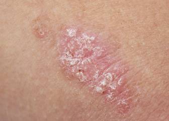 La psoriasis afecta a más de un millón de personas en España