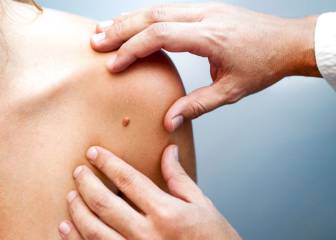 El 90% de los cánceres cutáneos son carcinomas