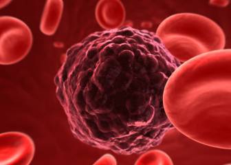 El mieloma múltiple, una enfermedad rara que afecta a 12.000 personas en España